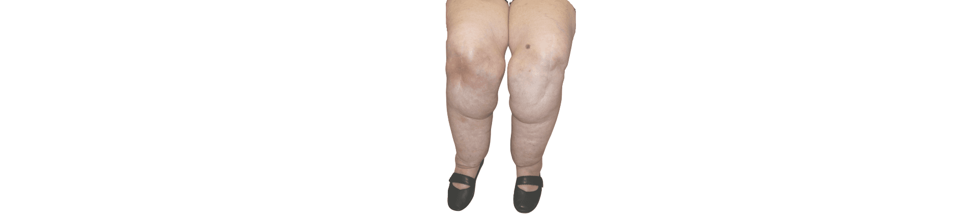 Cankle Liposuction in Rotherham
