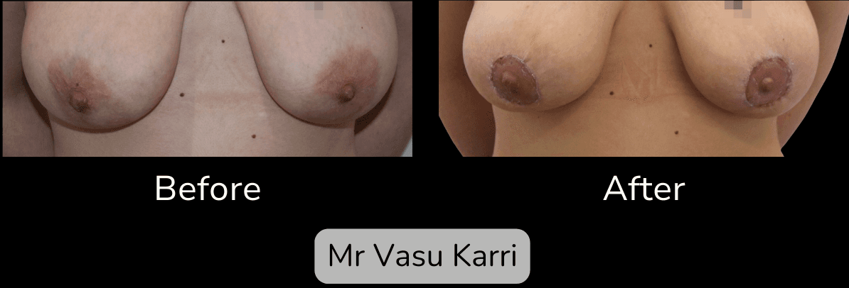Areola Reduction in Rotherham Before & After 1