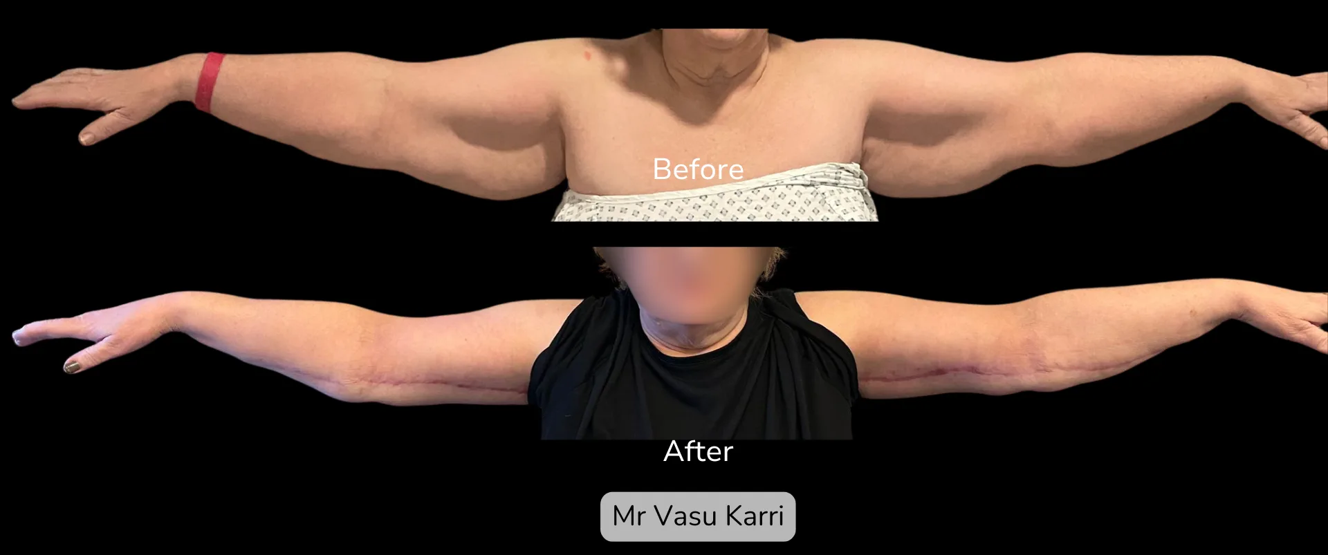 Before and after Arm Reduction (Bingo Wings), patient 0.1