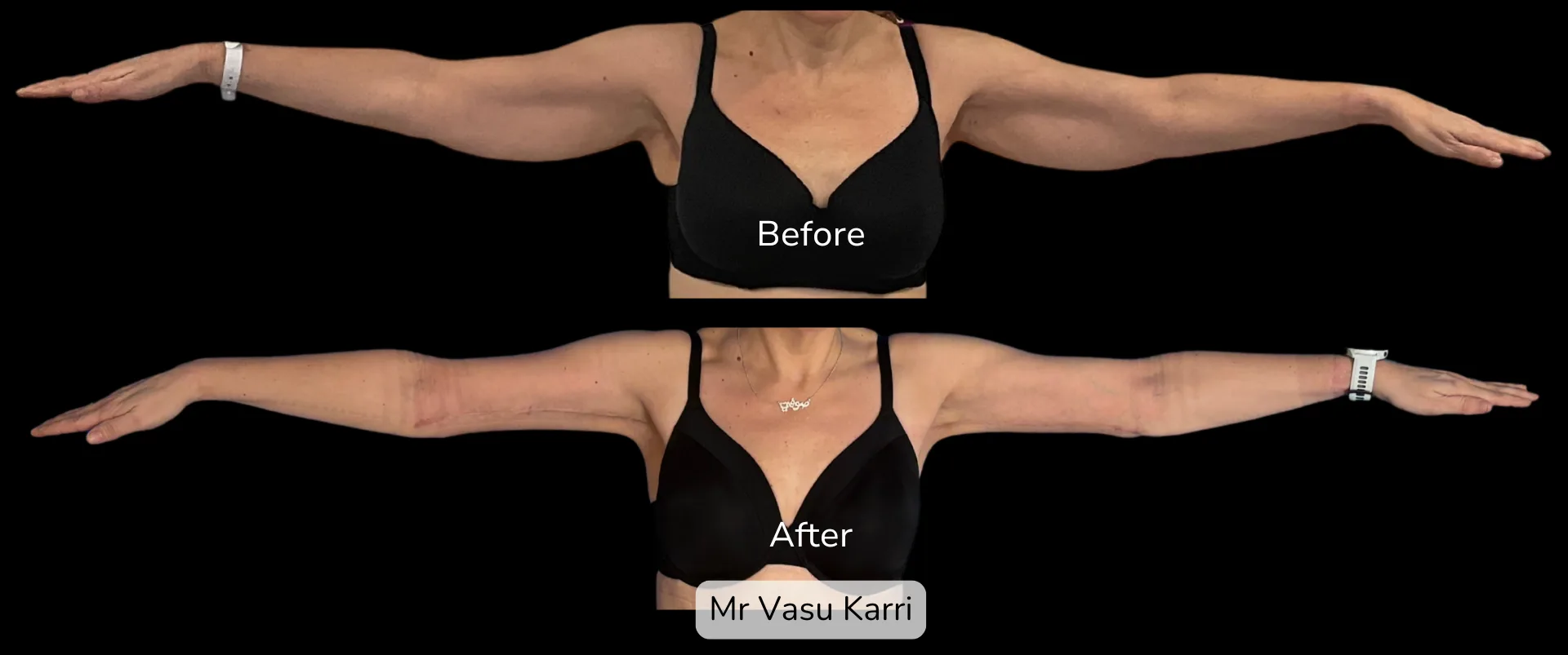 Before and after Arm Reduction (Bingo Wings), patient 1