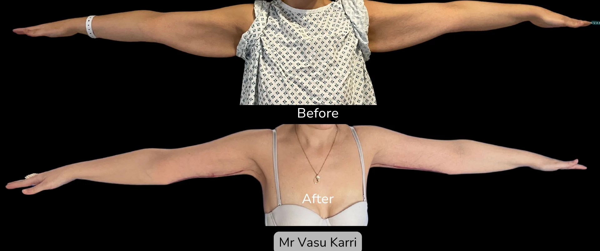 Before and after Arm Reduction (Bingo Wings), patient 10
