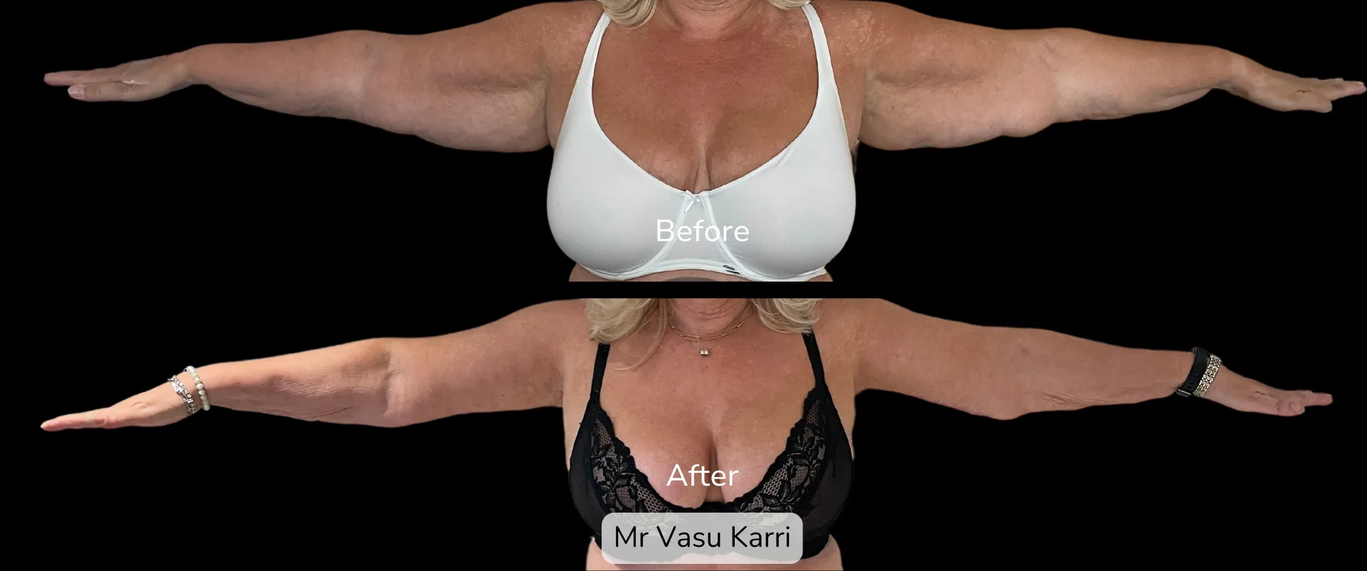 Before and after Arm Reduction (Bingo Wings), patient 11