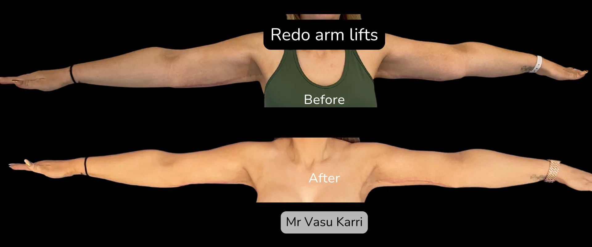 Before and after Arm Reduction (Bingo Wings), patient 12