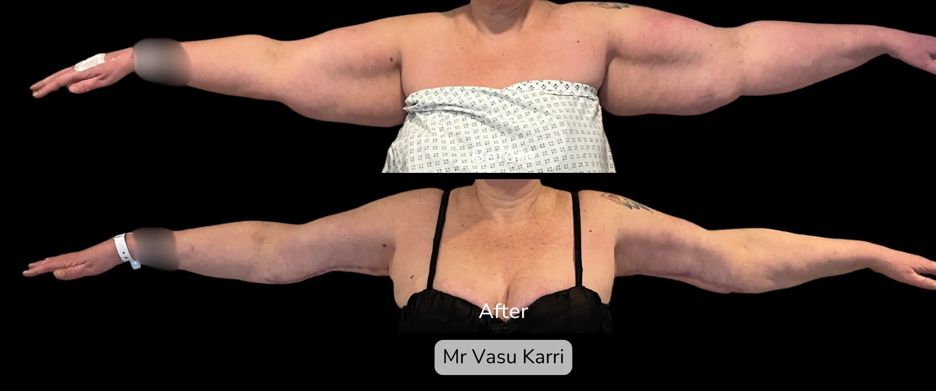 Before and after Arm Reduction (Bingo Wings), patient 13