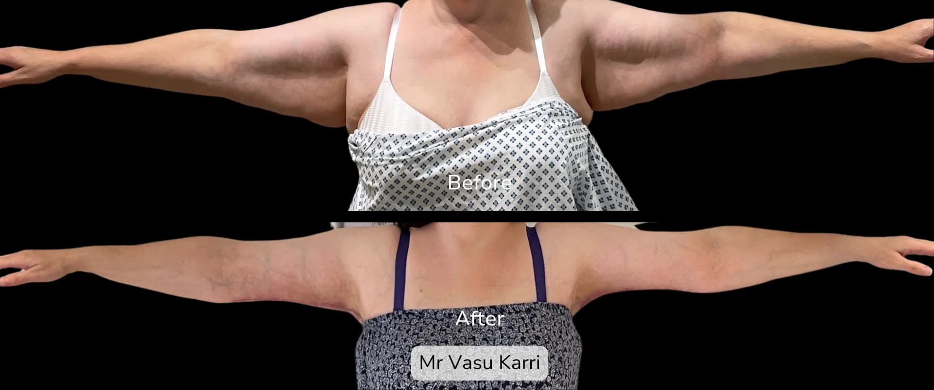 Before and after Arm Reduction (Bingo Wings), patient 14