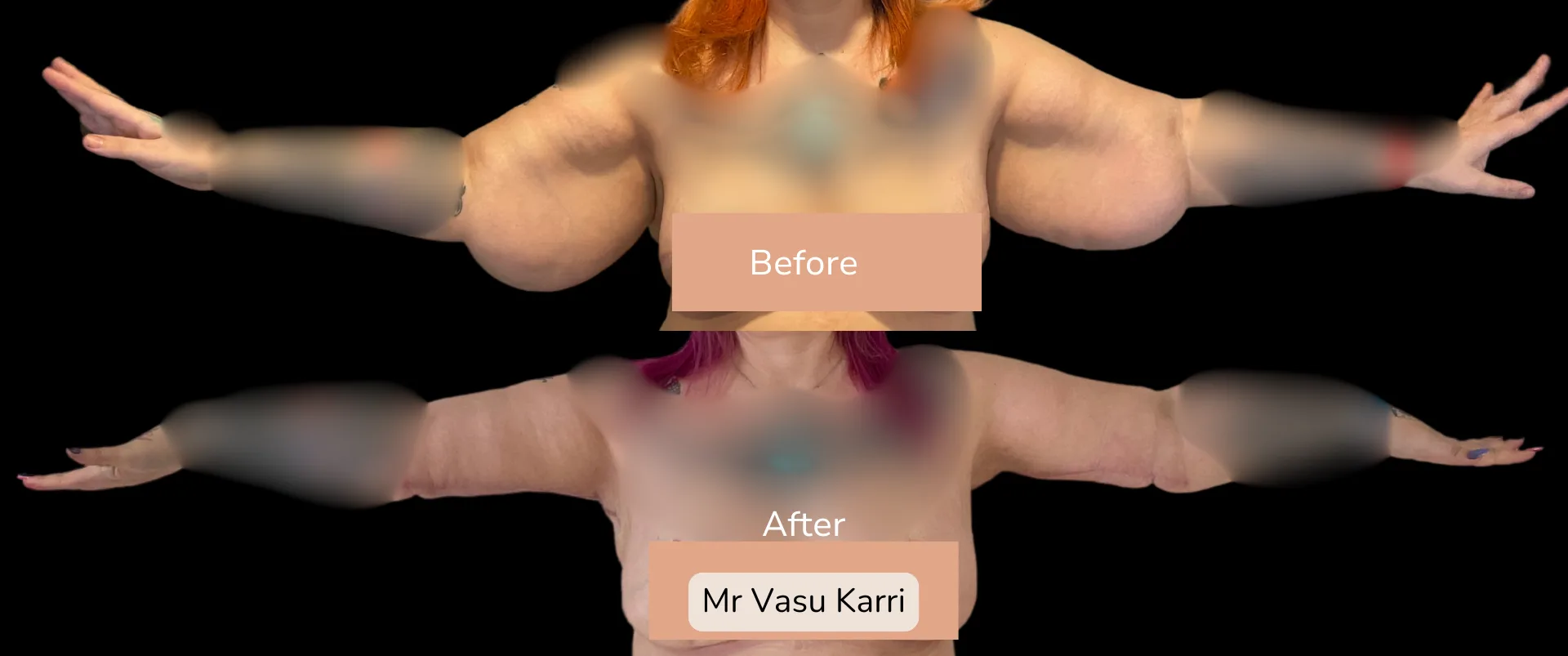 Before and after Arm Reduction (Bingo Wings), patient 15
