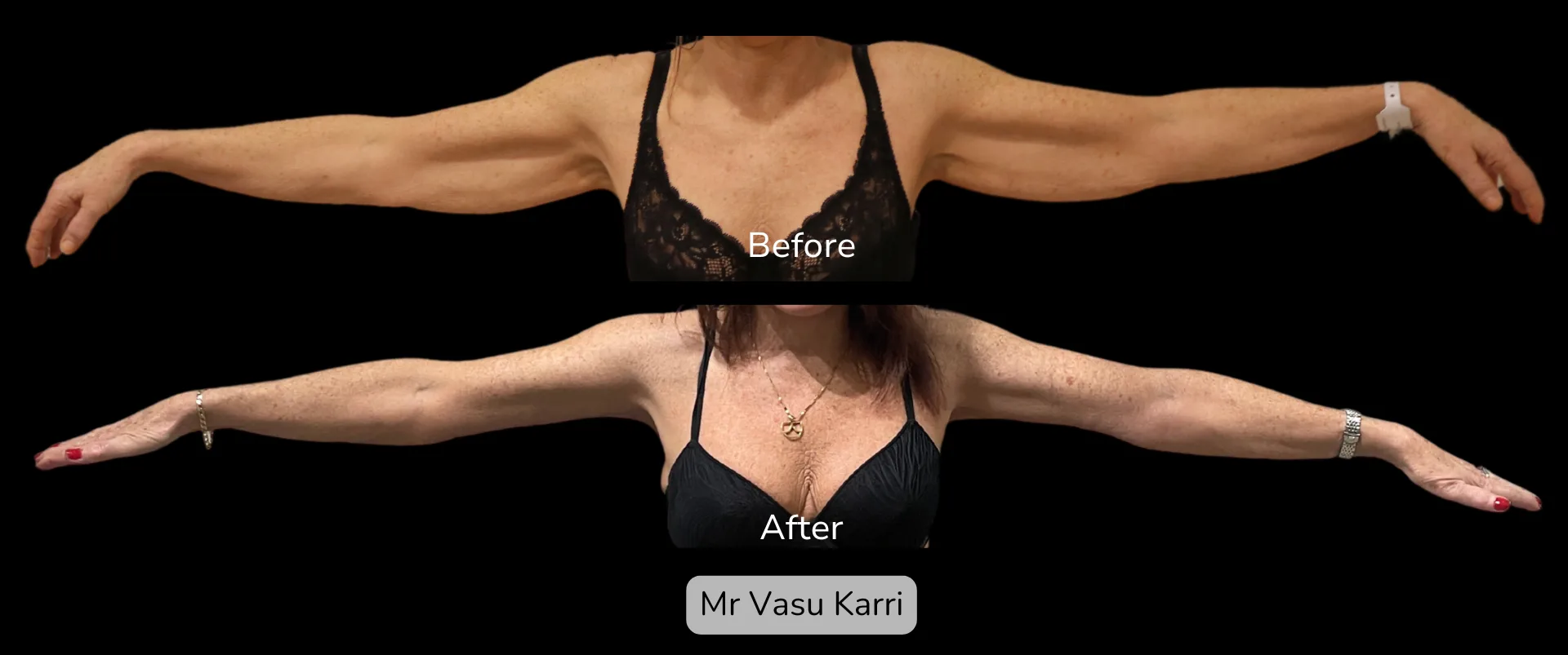 Before and after Arm Reduction (Bingo Wings), patient 16