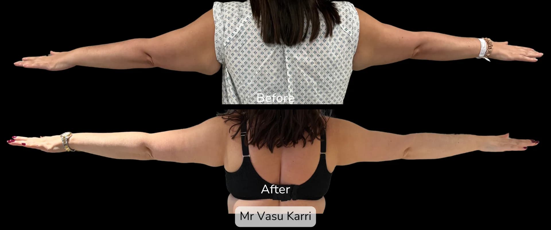 Before and after Arm Reduction (Bingo Wings), patient 17