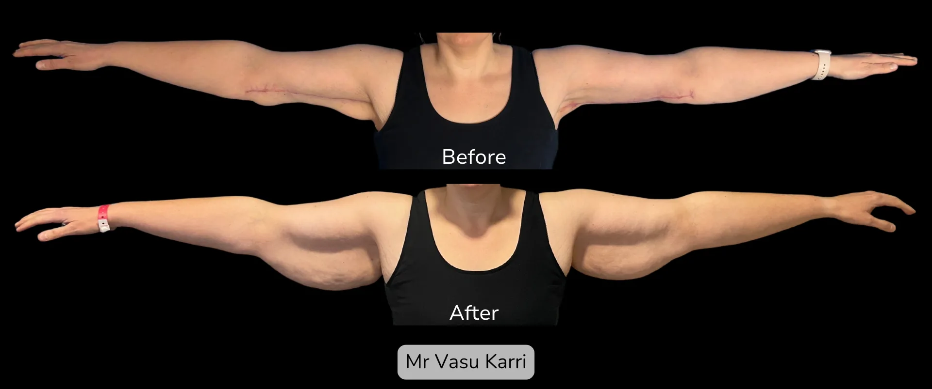 Before and after Arm Reduction (Bingo Wings), patient 2