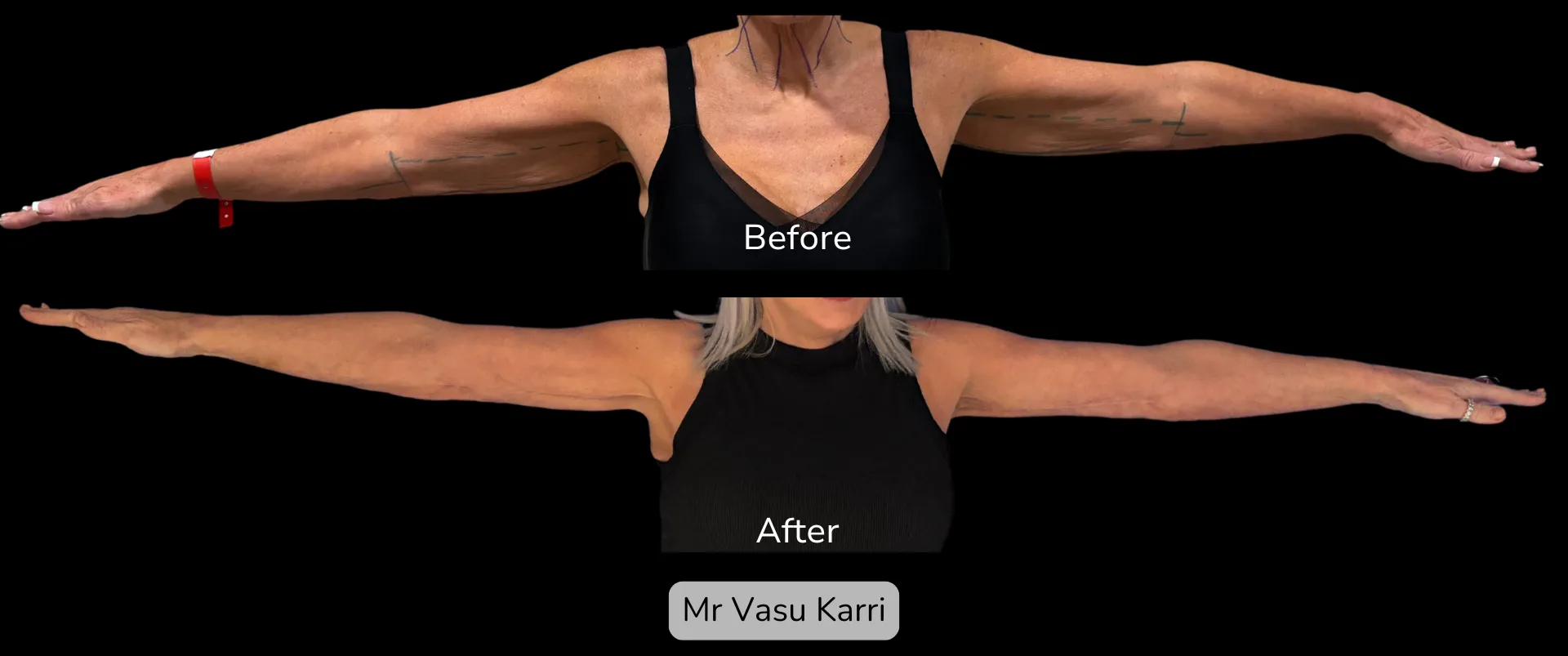 Before and after Arm Reduction (Bingo Wings), patient 3