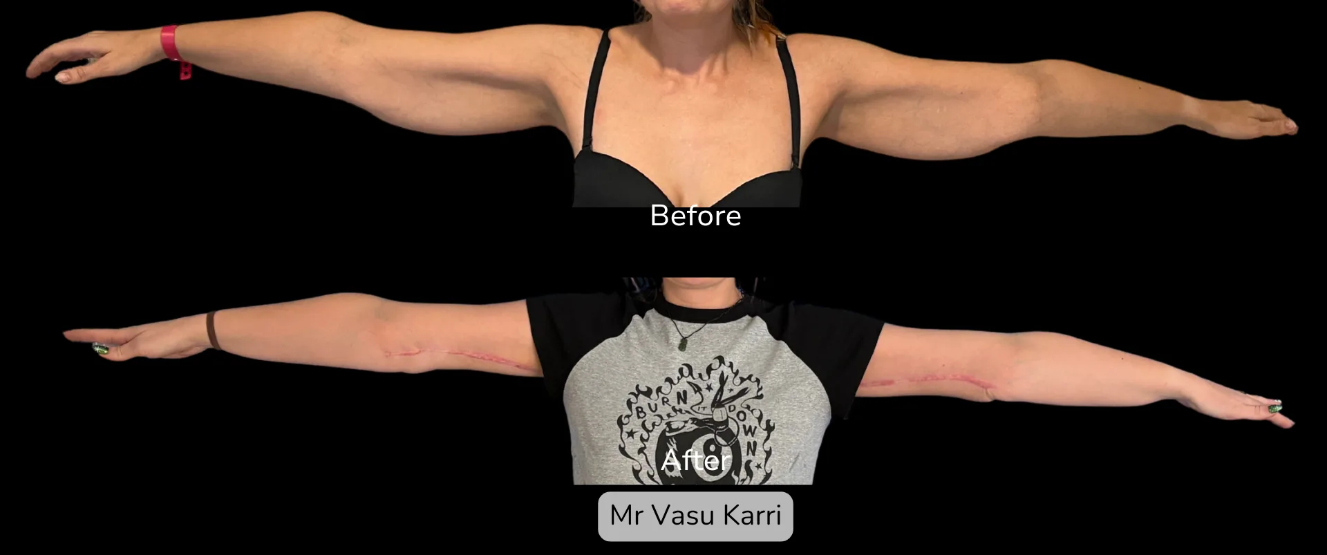 Before and after Arm Reduction (Bingo Wings), patient 4