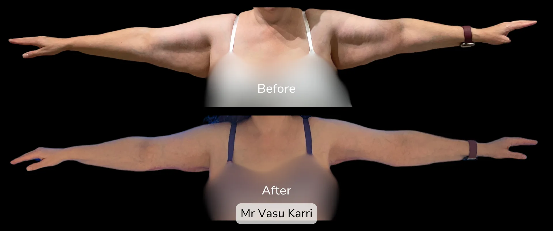 Before and after Arm Reduction (Bingo Wings), patient 5