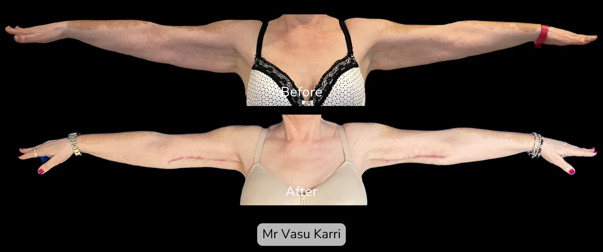 Before and after Arm Reduction (Bingo Wings), patient 6