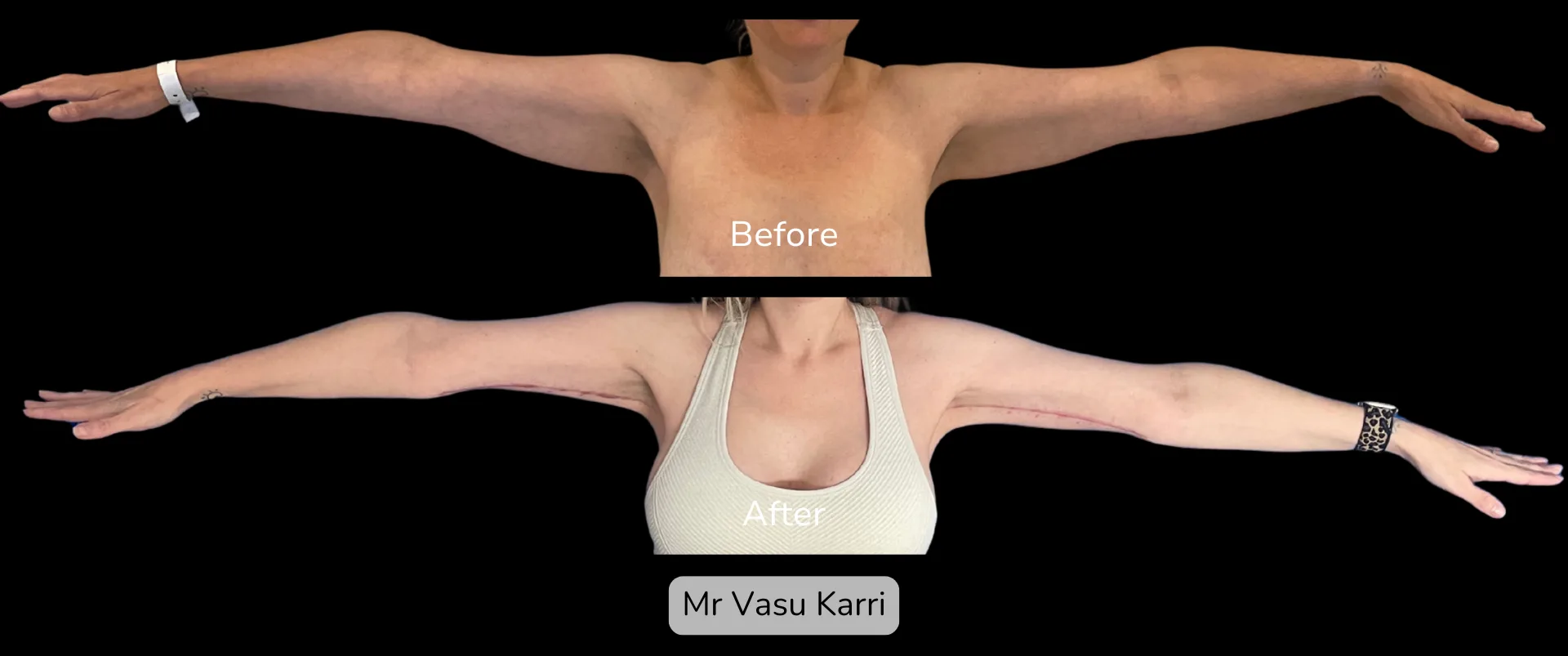 Before and after Arm Reduction (Bingo Wings), patient 7
