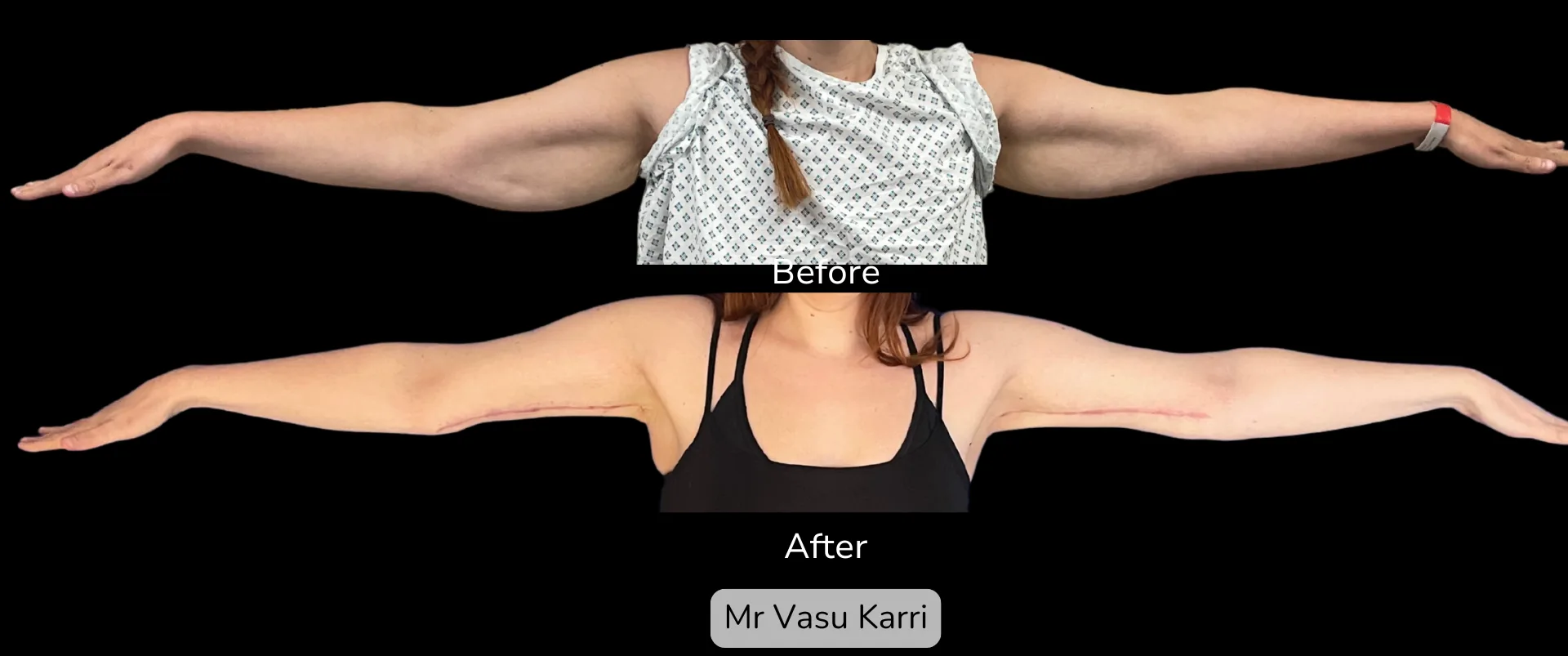 Before and after Arm Reduction (Bingo Wings), patient 8