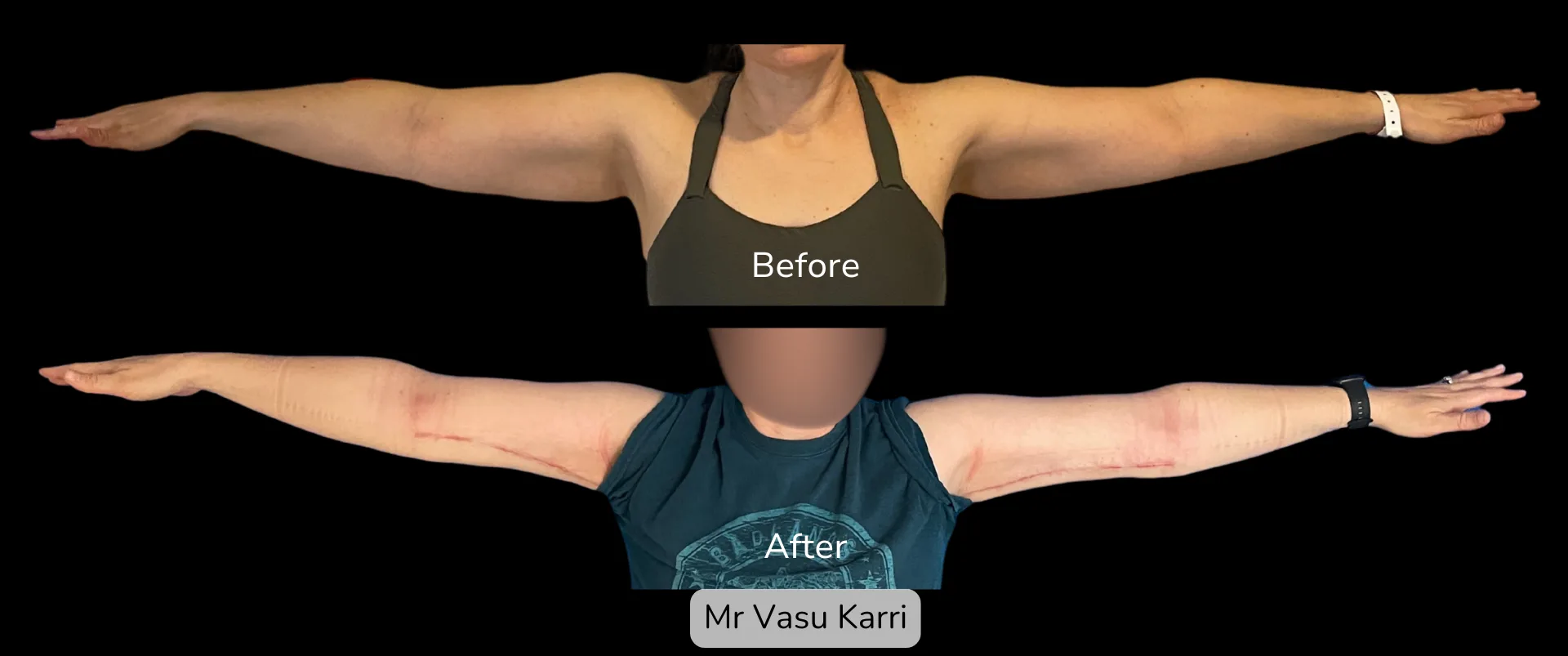 Before and after Arm Reduction (Bingo Wings), patient 9