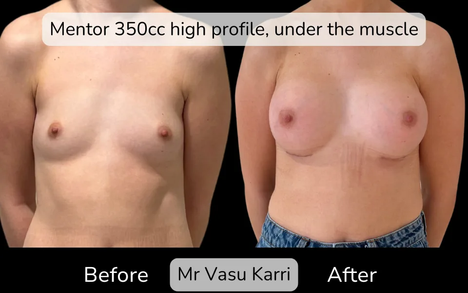 Before and after Breast Enlargement, patient 0.9