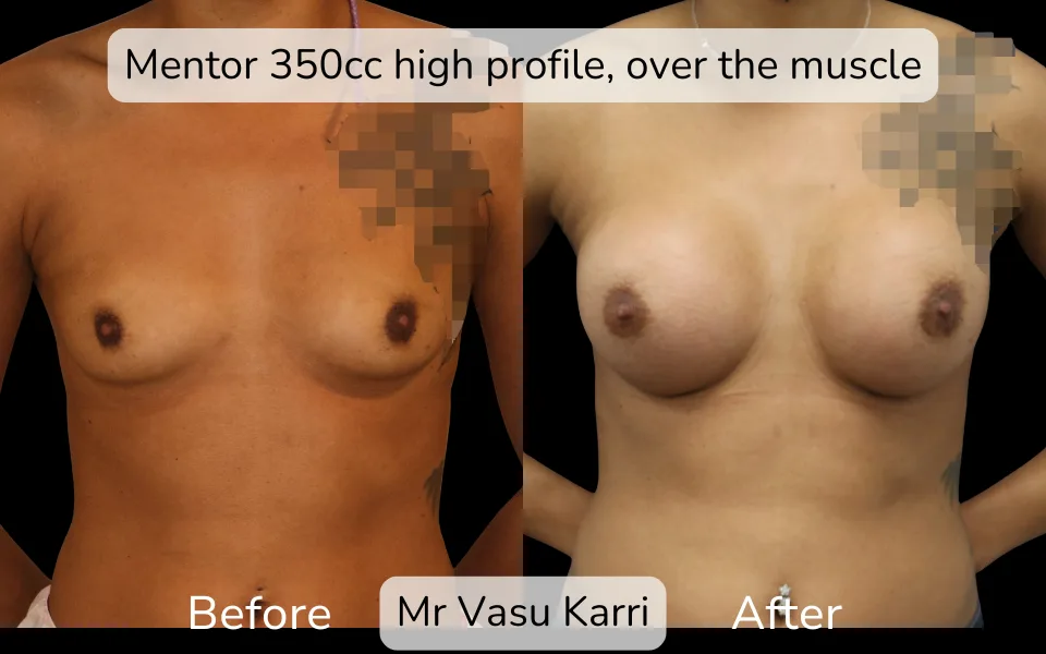 Before and after Breast Enlargement, patient 1