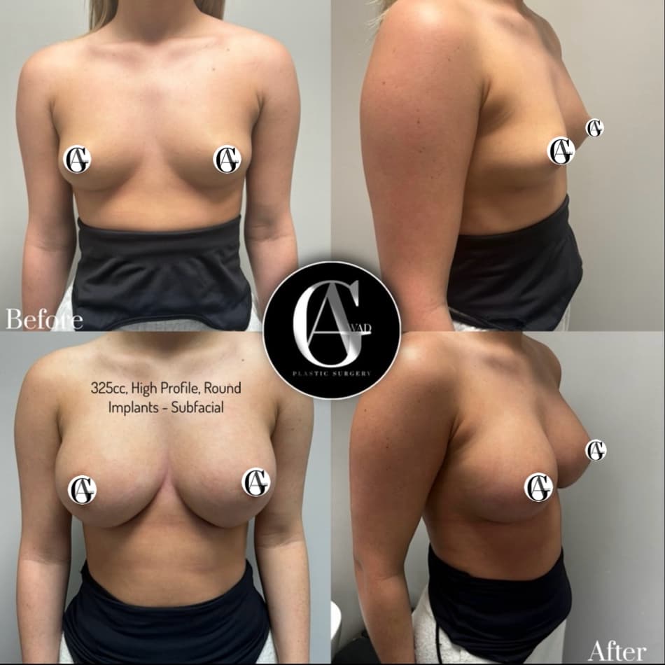 Breast Enlargement before and after