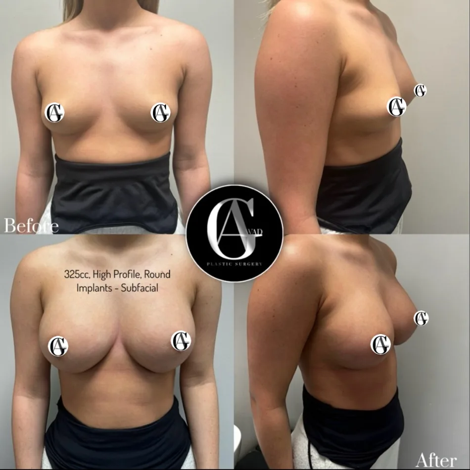 Before and after Breast Enlargement, patient 23