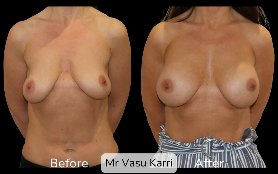 Before and after Breast Enlargement, patient 10