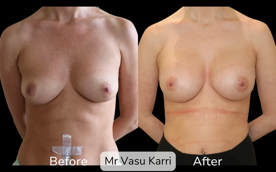 Before and after Breast Enlargement, patient 11