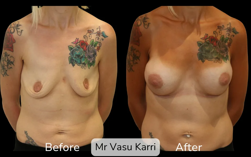 Before and after Breast Enlargement, patient 12