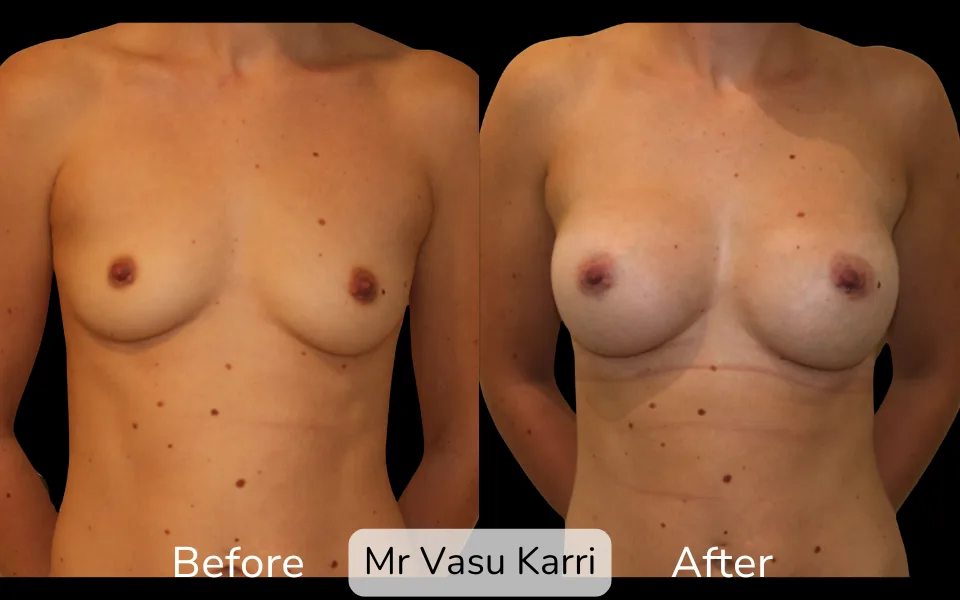Before and after Breast Enlargement, patient 13