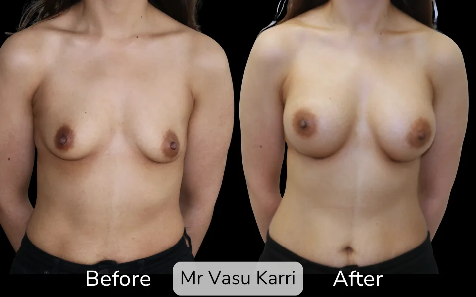 Before and after Breast Enlargement, patient 14