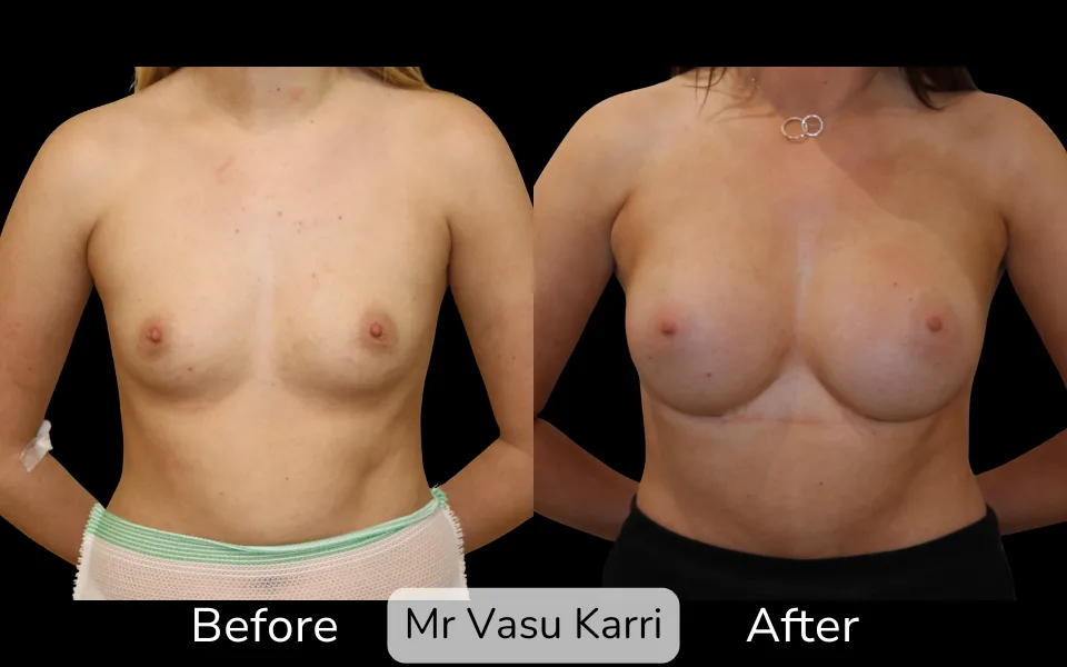 Before and after Breast Enlargement, patient 15