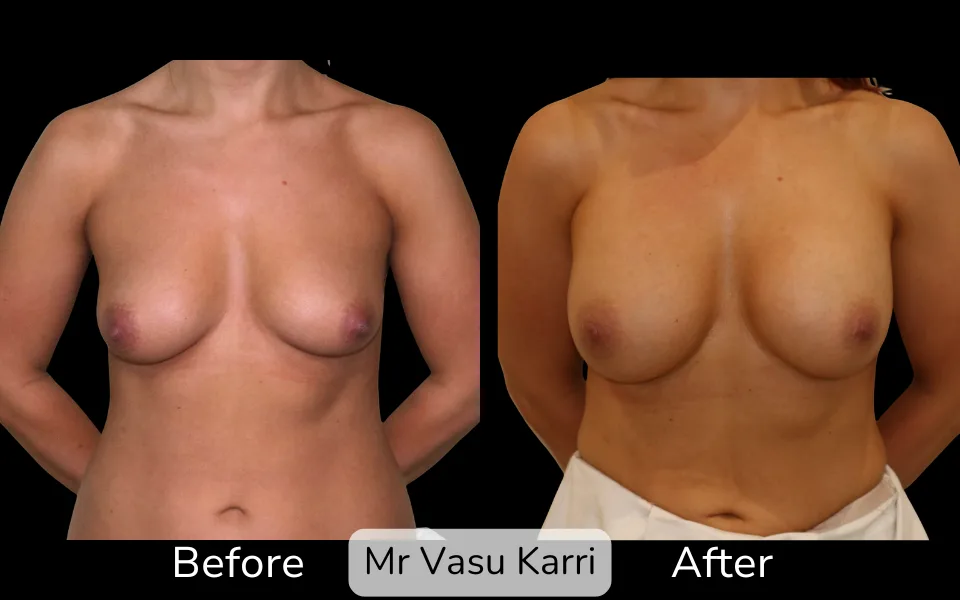 Before and after Breast Enlargement, patient 16