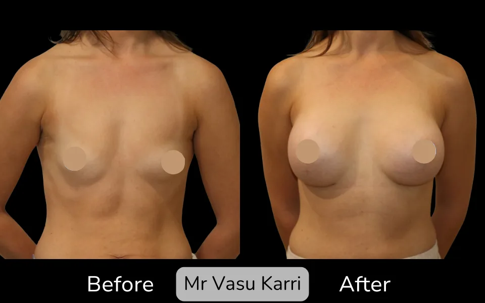 Before and after Breast Enlargement, patient 17