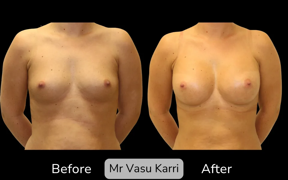 Before and after Breast Enlargement, patient 18