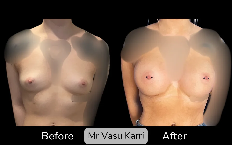 Before and after Breast Enlargement, patient 19