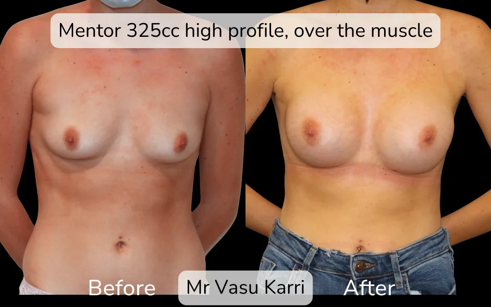 Before and after Breast Enlargement, patient 2