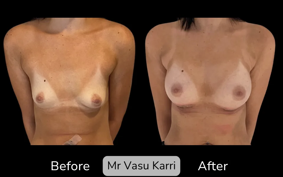 Before and after Breast Enlargement, patient 20