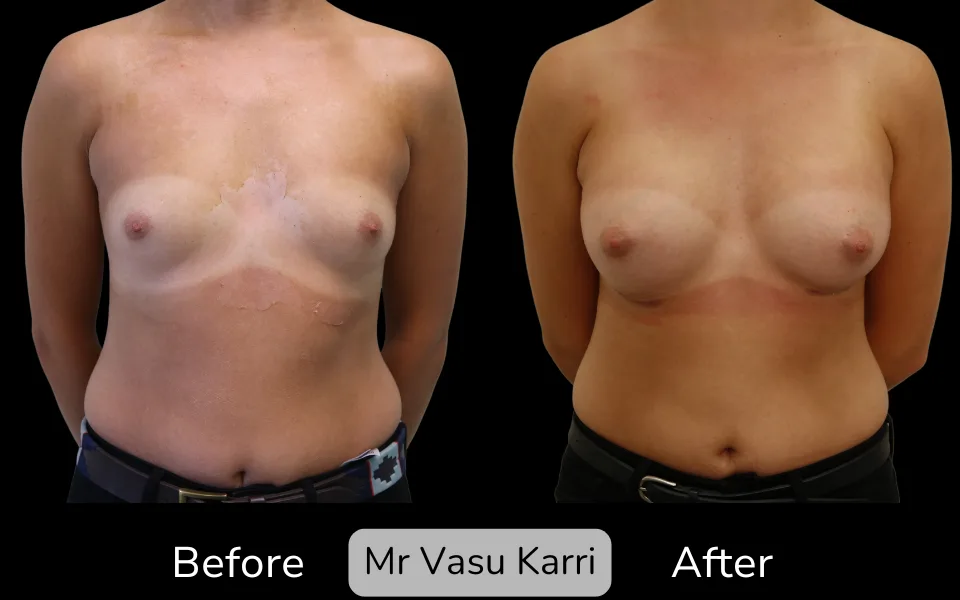 Before and after Breast Enlargement, patient 21