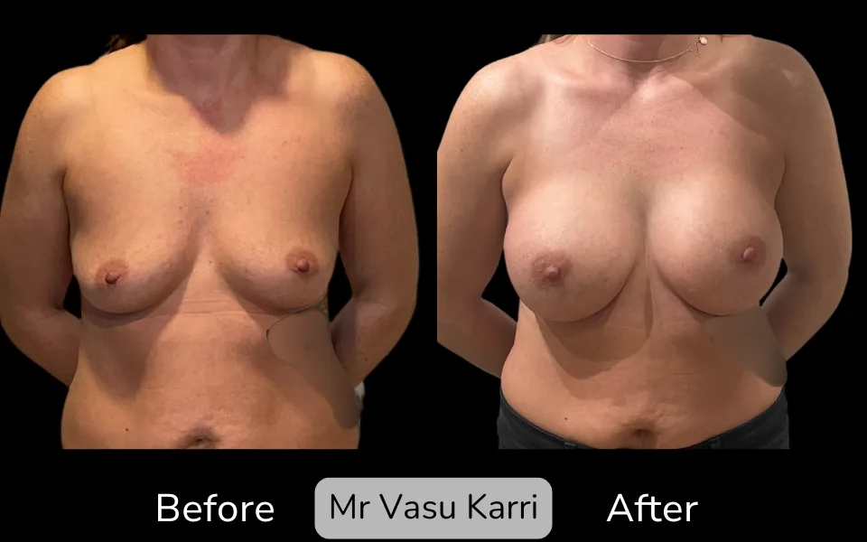 Before and after Breast Enlargement, patient 22