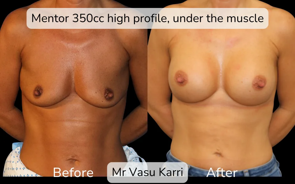 Before and after Breast Enlargement, patient 3
