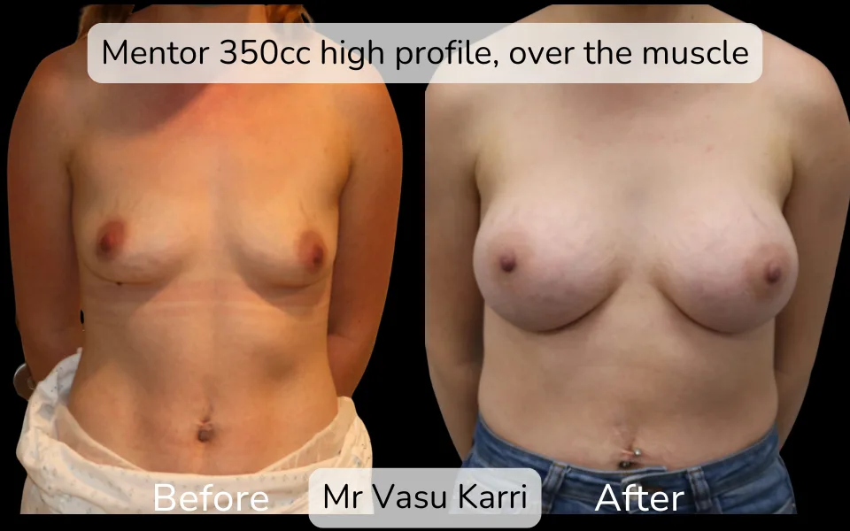 Before and after Breast Enlargement, patient 4