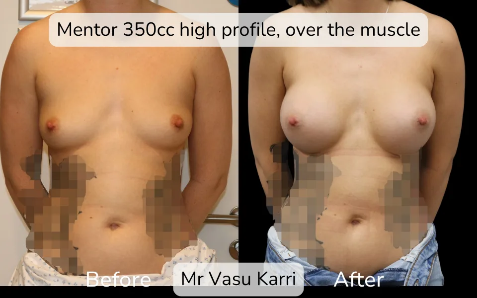 Before and after Breast Enlargement, patient 5