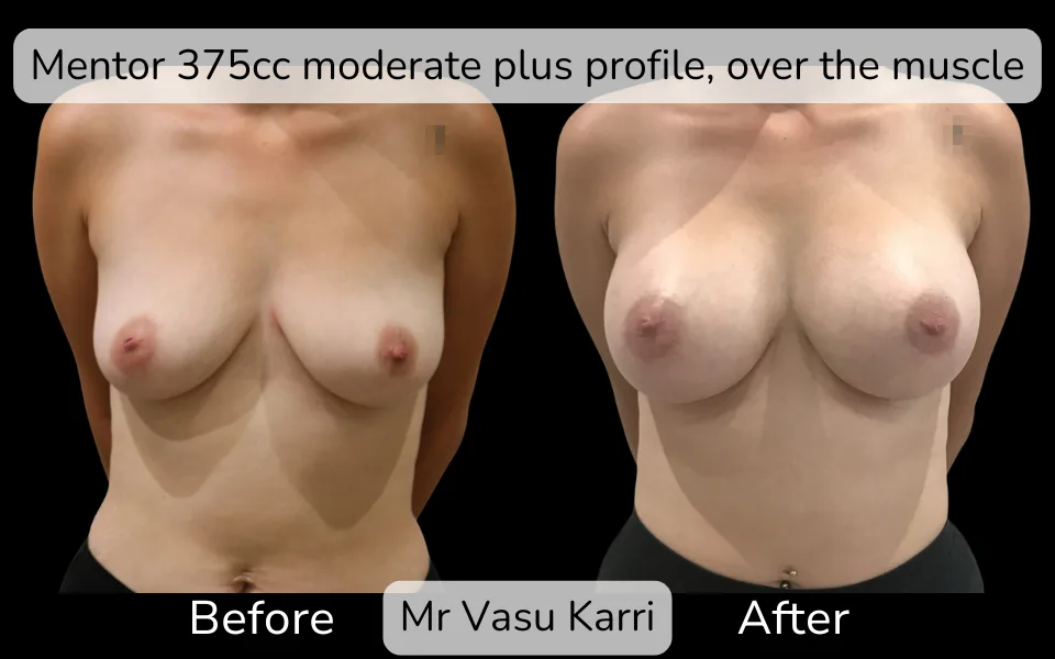 Before and after Breast Enlargement, patient 6