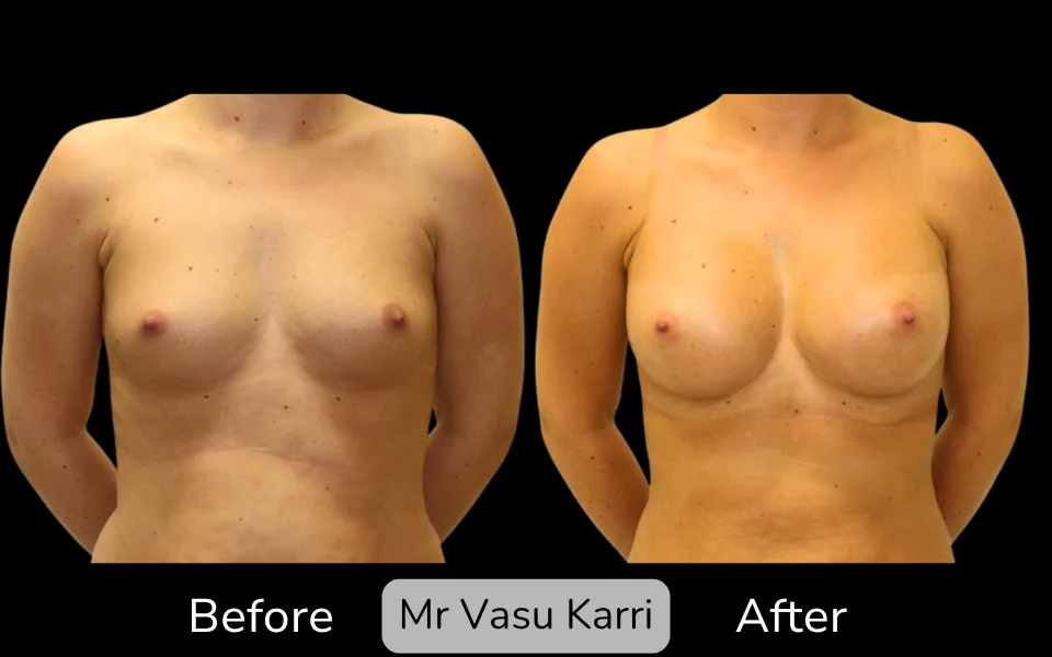Before and after Breast Enlargement, patient 7