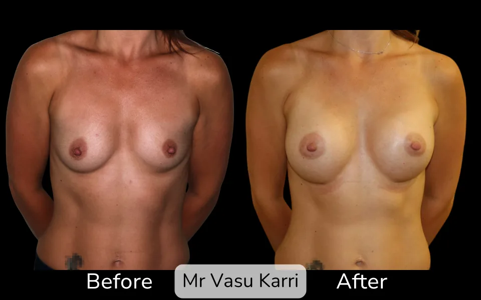 Before and after Breast Enlargement, patient 8