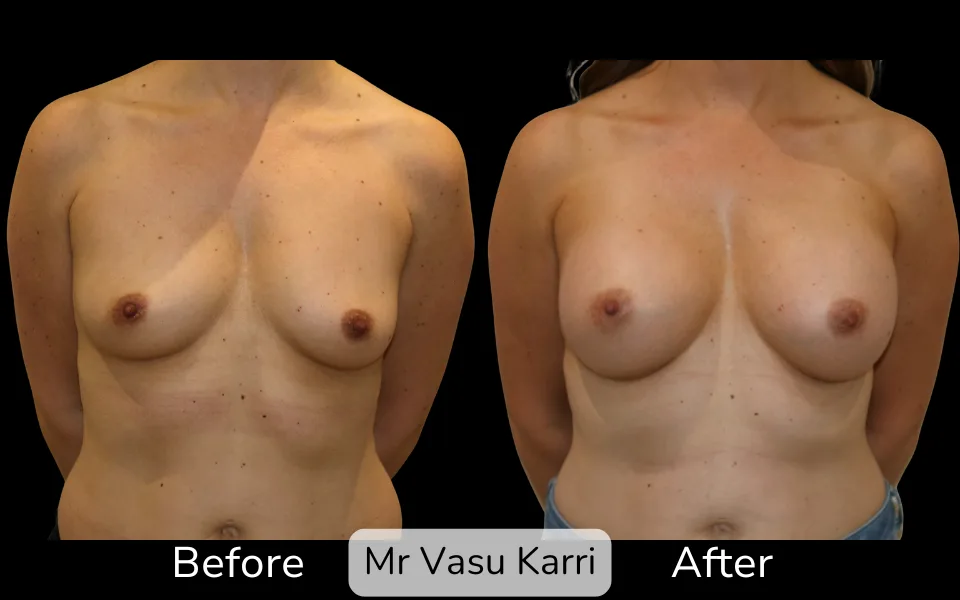 Before and after Breast Enlargement, patient 9