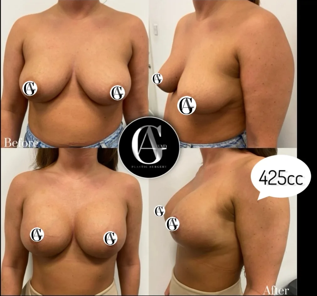 Before and after Breast Enlargement and Lift, patient 1
