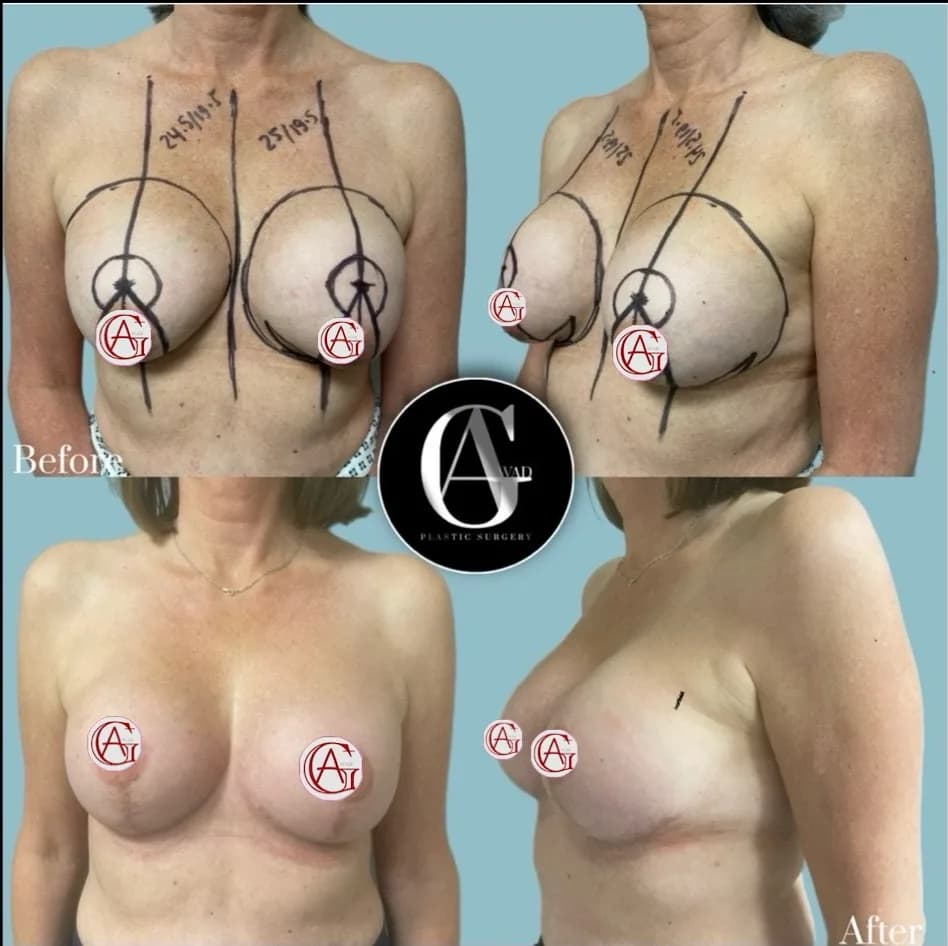 Before and after Breast Enlargement and Lift, patient 6