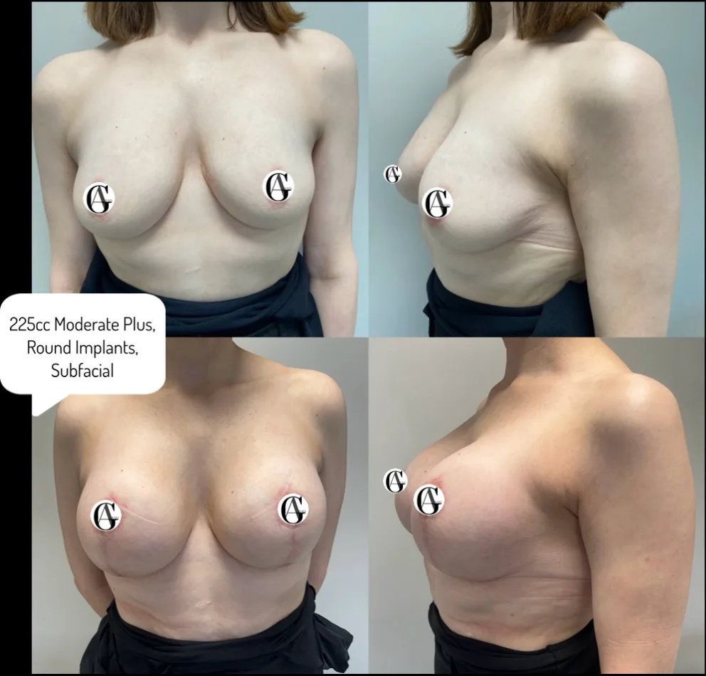 Before and after Breast Enlargement and Lift, patient 3