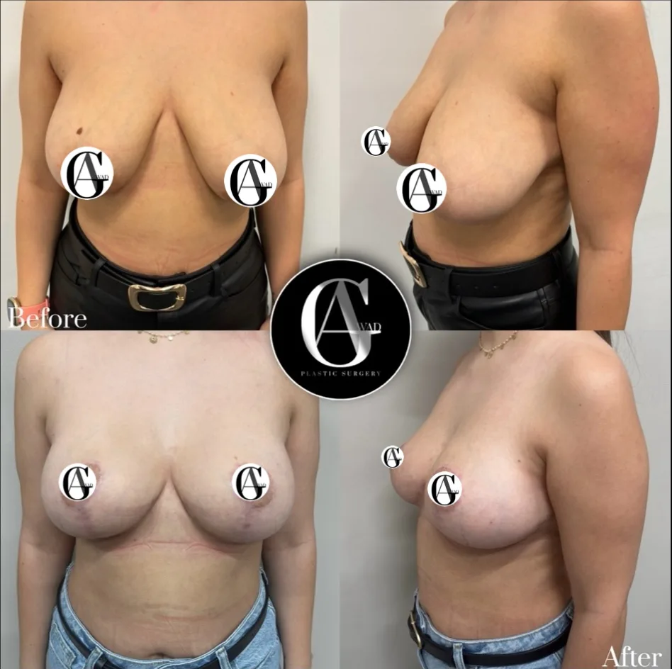 Before and after Breast Enlargement and Lift, patient 4