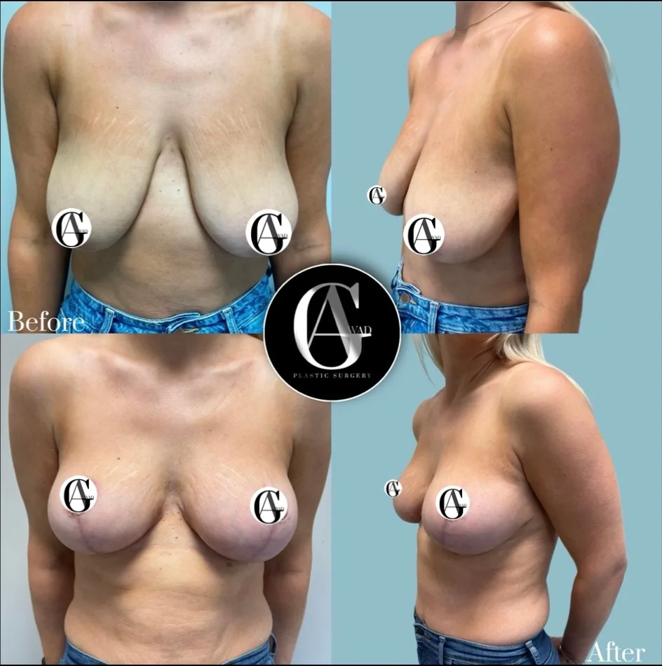 Before and after Breast Lift (Mastopexy), patient 1